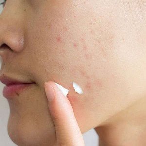 SKIN1004 Madagascar Centella Tea - Trica Spot Cream | Crema Calmante Anti - Imperfecciones (20 ml) - Montber Professional Brand